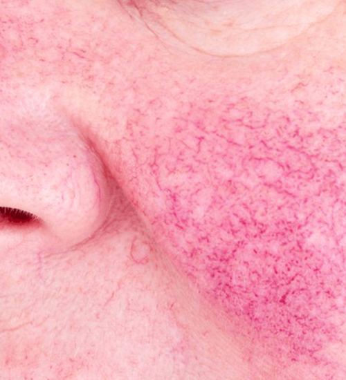 holcomb-pure-dermatology-broken-blood-vessels-1