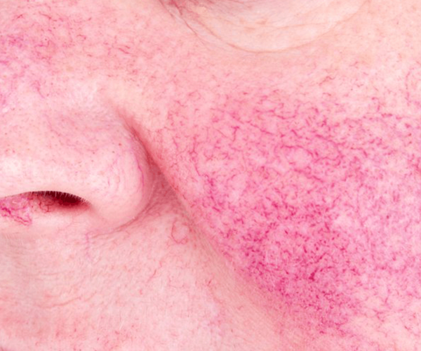 holcomb-pure-dermatology-broken-blood-vessels-1