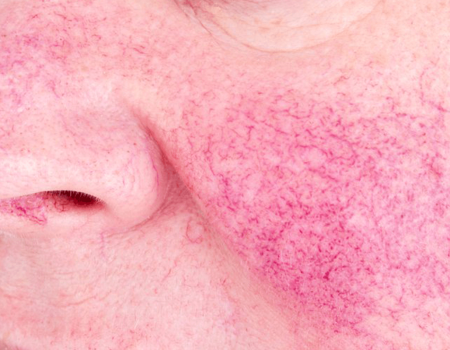 holcomb-pure-dermatology-broken-blood-vessels-1