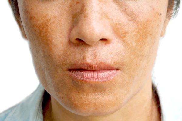 holcomb-pure-dermatology-melasma-sun-spots-1