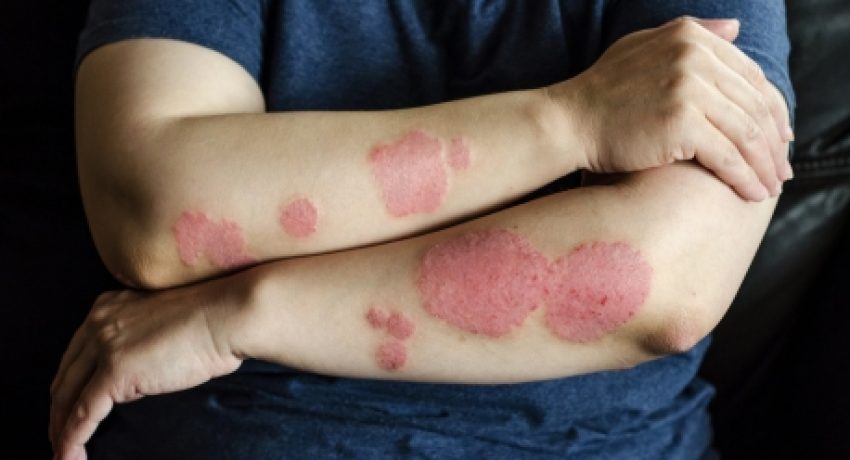 psoriasis preparation for seasonal changes