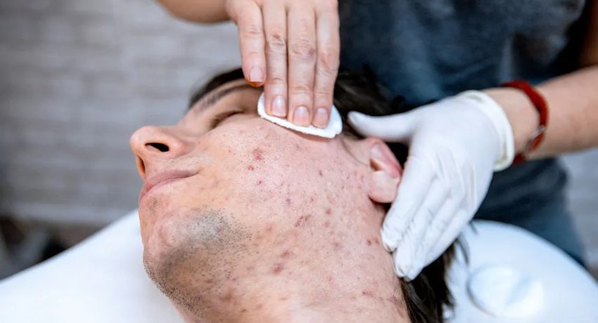 img-can-dermatologists-cure-acne-permanently
