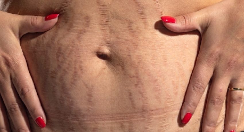 treatment options for stretch marks