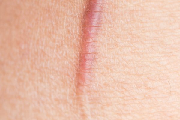 scar