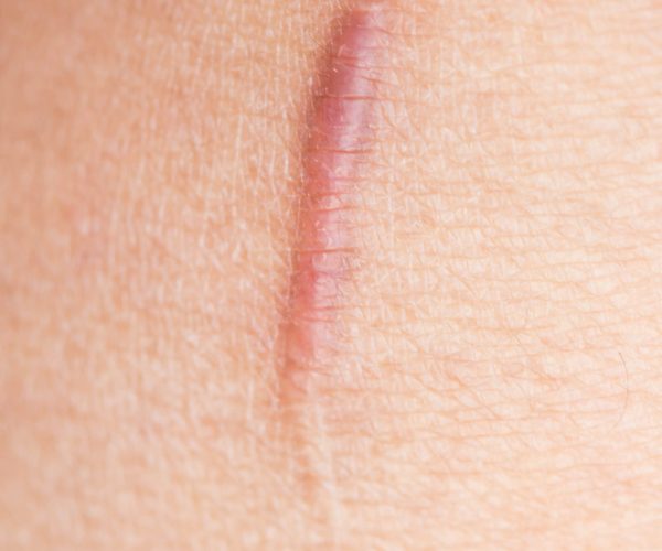 scar