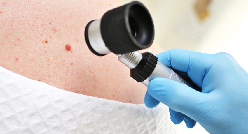skin-cancer-treatment-in-Alexandria