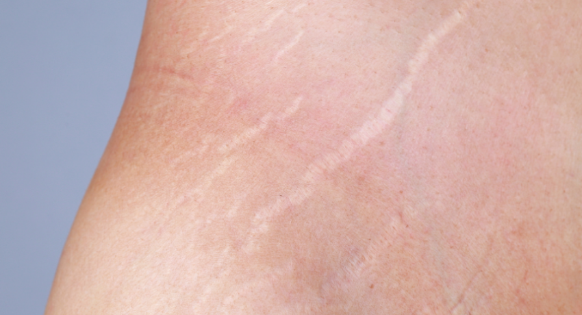 stretch marks alexandria