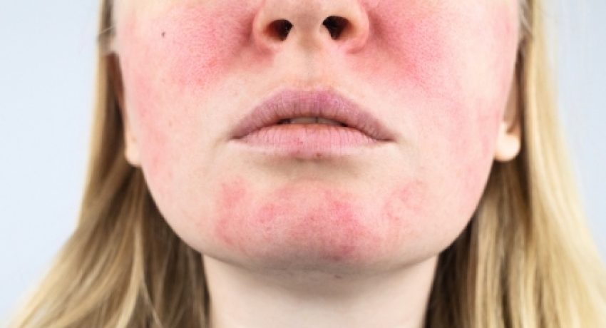 What Is The Most Effective Treatment For Rosacea